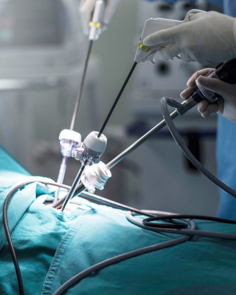 cirugía-de-apendice